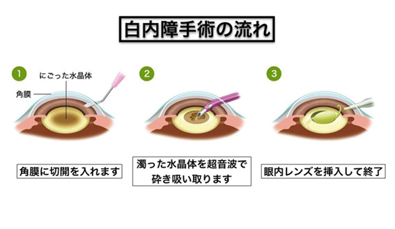 白内障手術の流れ