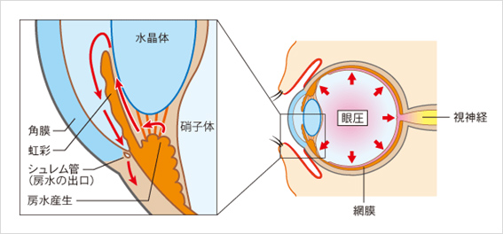 緑内障の原因と種類