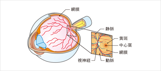 加齢黄斑変性