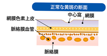 加齢黄斑変性の原因