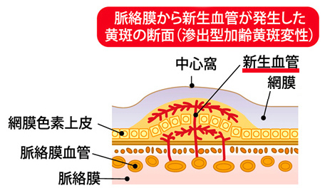 加齢黄斑変性の原因