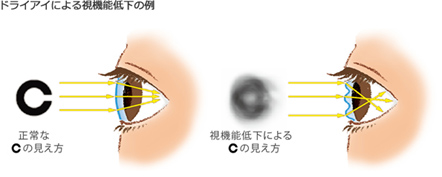 ドライアイ・白内障など