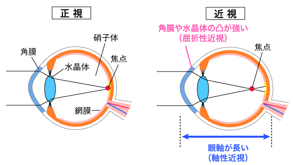 近視とは